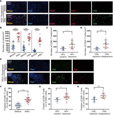 The effects of 5-aminolevulinic acid photodynamic therapy on the local immune response of women with cervical intraepithelial neoplasia grade 2